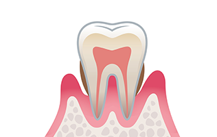 3）中度歯周炎