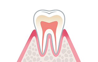 1）歯肉炎