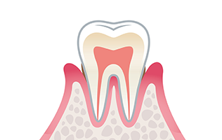 2）軽度歯周炎