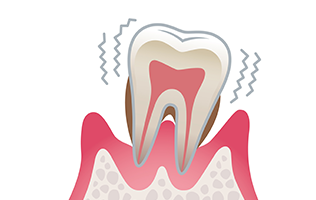 4）重度歯周炎